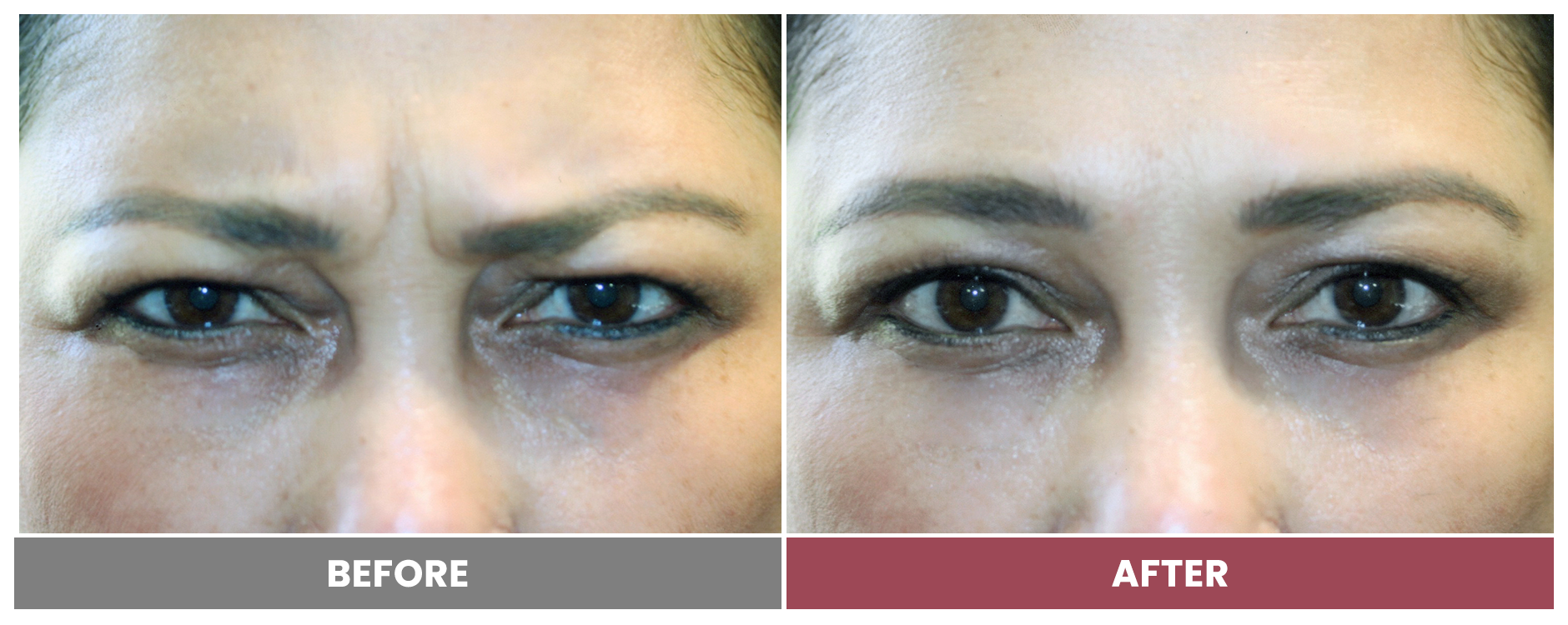 BOTOX FOR WRINKLES & BROW LIFT - Case 15